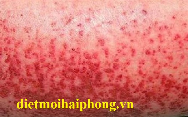 Ph&aacute;t ban do sốt xuất huyết